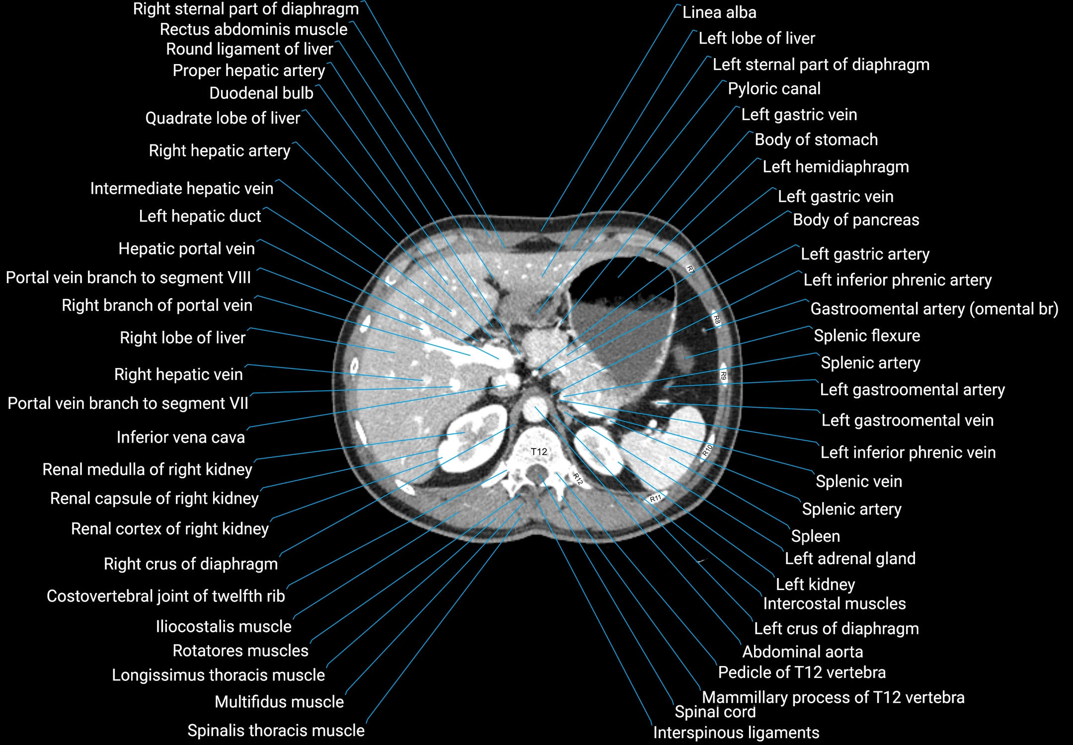 CT male pelvis axial cross sectional anatomy labelled radiology image -00041.webp